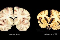Športi, ki poškodujejo možgane tekmovalcev: najbolj ogroženi boksarji in igralci ameriškega nogometa